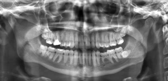 Dental_Digital_X-rays