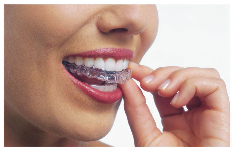 Invisalign-Landing-Page