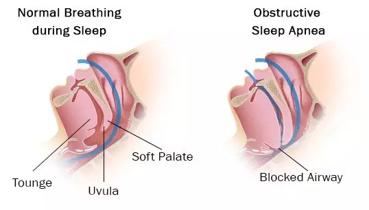 Sleep-Apnea-Diagram