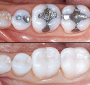 fillings