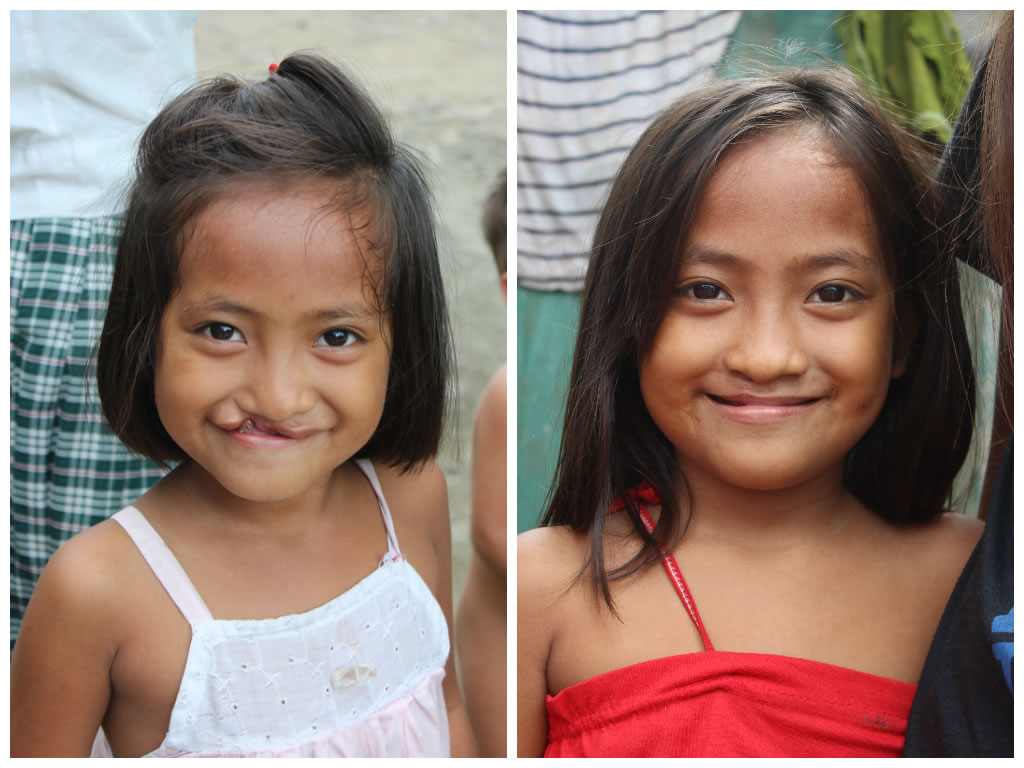 smile train before-and-after-january-2