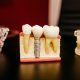 Dental-Implants-vs-Dental-Bridges-Which-Is-Better-for-Me