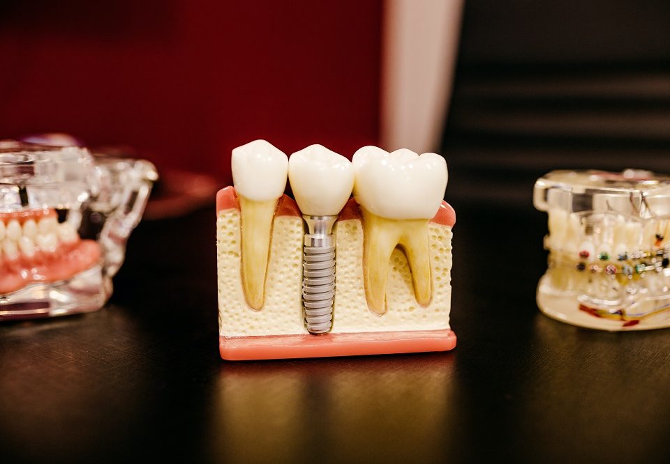 Dental-Implants-vs-Dental-Bridges-Which-Is-Better-for-Me