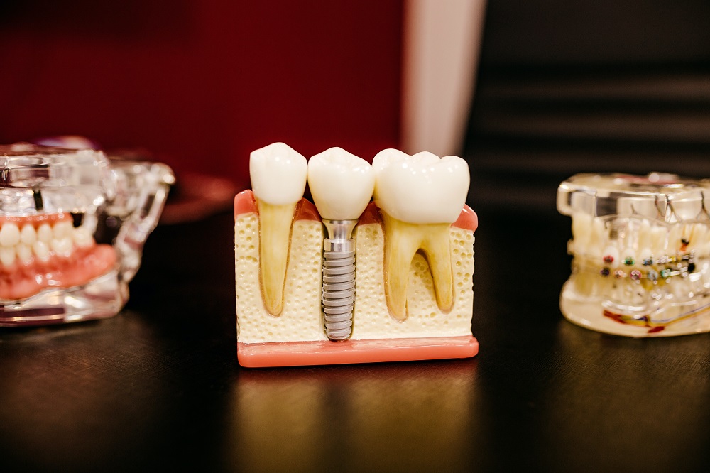 Dental-Implants-vs-Dental-Bridges-Which-Is-Better-for-Me