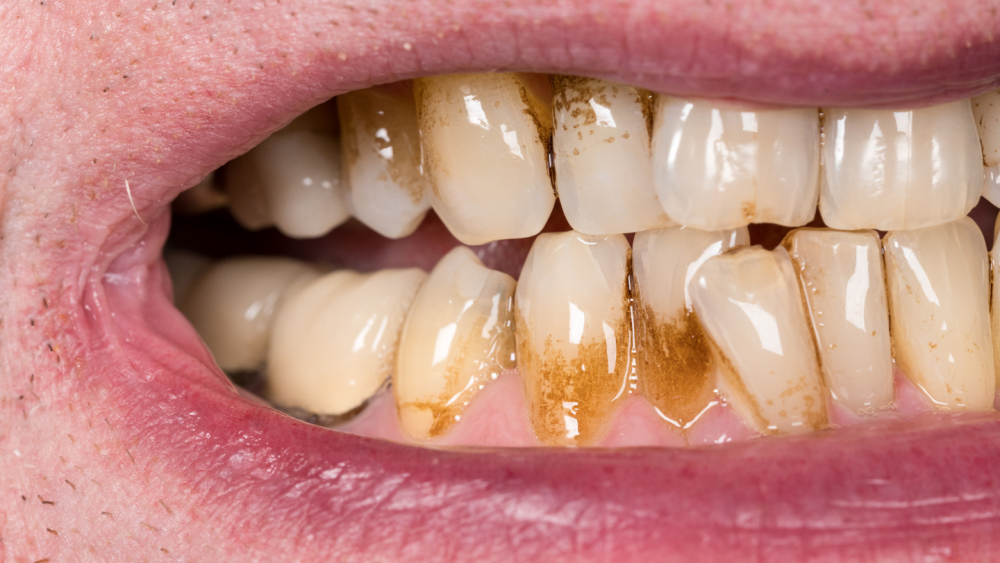 How To Get Rid Of Teeth Stains