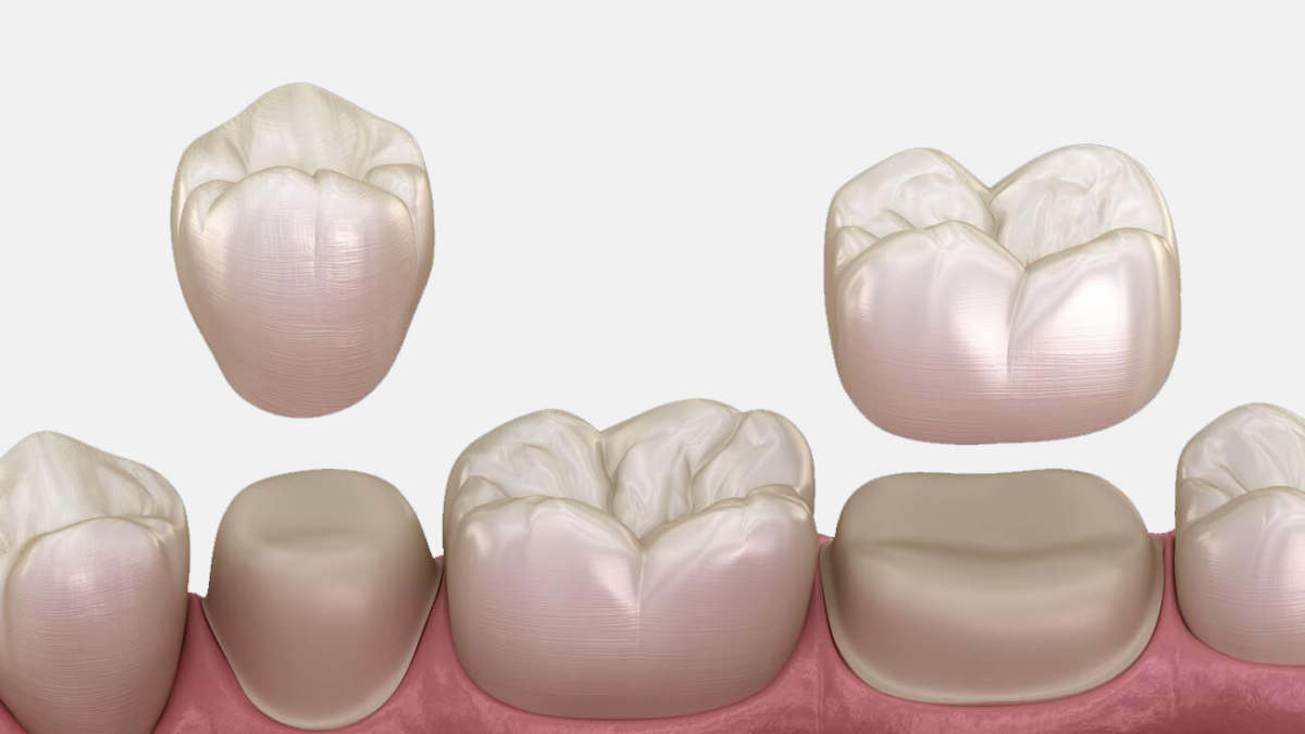 same-day crown vs. traditional