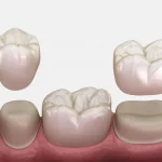 same-day crown vs. traditional