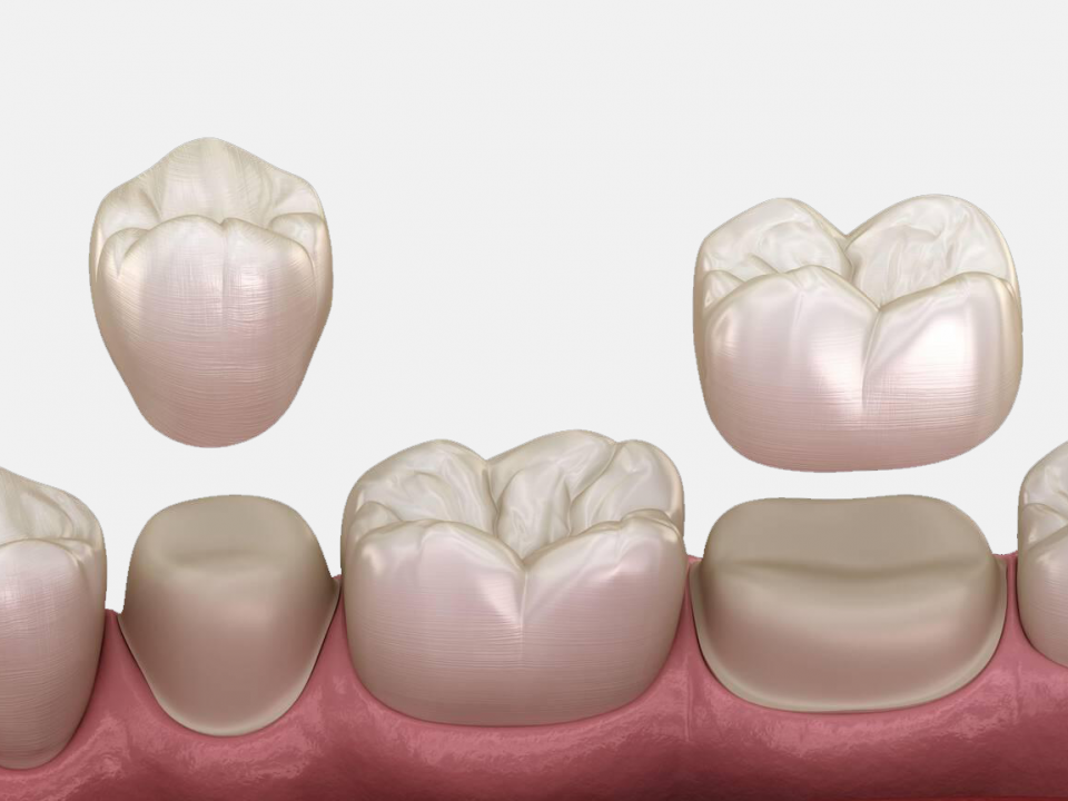 same-day crown vs. traditional