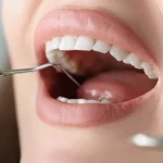 what causes mouth cancer