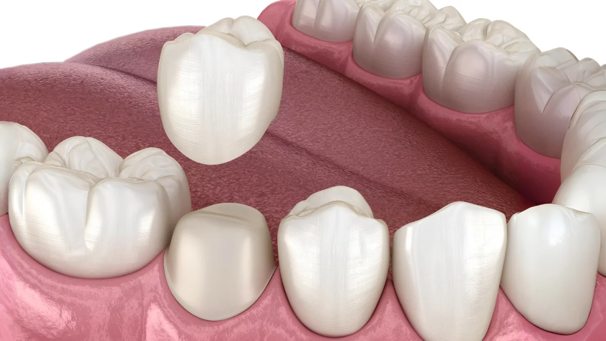 what is a cerec crown