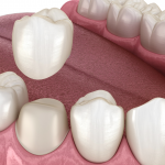what is a cerec crown