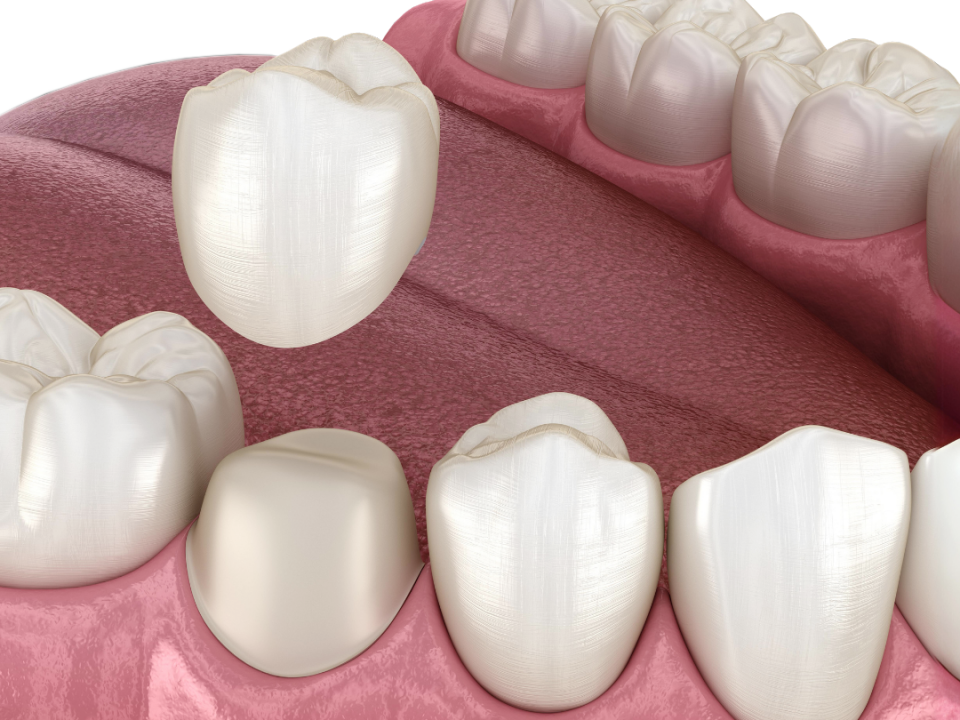 what is a cerec crown