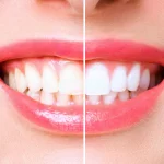 teeth whitening for the holidays